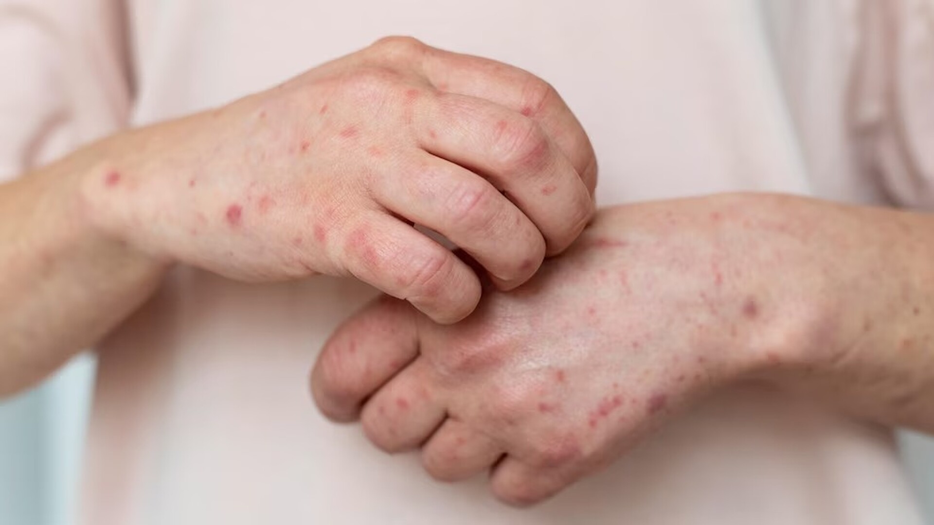 El virus varicela-zóster, responsable del brote de culebrilla, puede reactivarse tras años de la recuperación de la varicela.  Imagen tomada de Infobae.