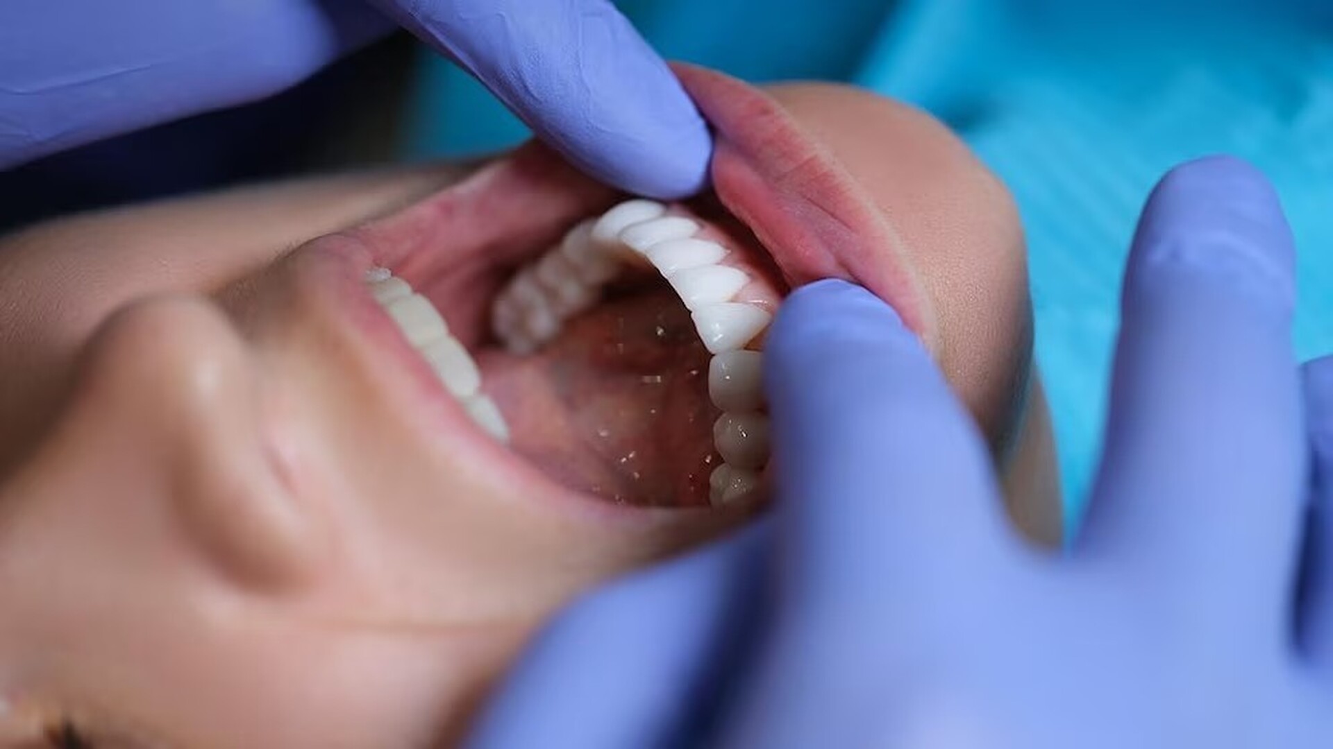 Las mujeres que no se cepillan ni usan hilo dental con frecuencia son más propensas a sufrir migrañas y fibromialgia, según un estudio reciente.  Imagen tomada de Infobae.