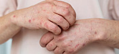 El virus varicela-zóster, responsable del brote de culebrilla, puede reactivarse tras años de la recuperación de la varicela.  Imagen tomada de Infobae.