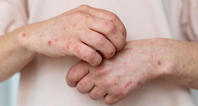 El virus varicela-zóster, responsable del brote de culebrilla, puede reactivarse tras años de la recuperación de la varicela.  Imagen tomada de Infobae.