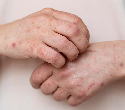 El virus varicela-zóster, responsable del brote de culebrilla, puede reactivarse tras años de la recuperación de la varicela.  Imagen tomada de Infobae.